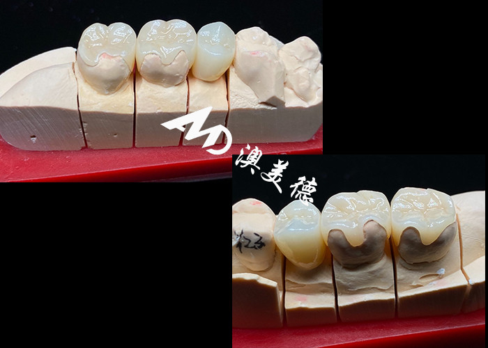 OEM Precision Fit Ceramic Inlays Onlays voor duurzame en natuurlijk uitziende tandheelkundige restauratie met superieure sterkte en betrouwbaarheid