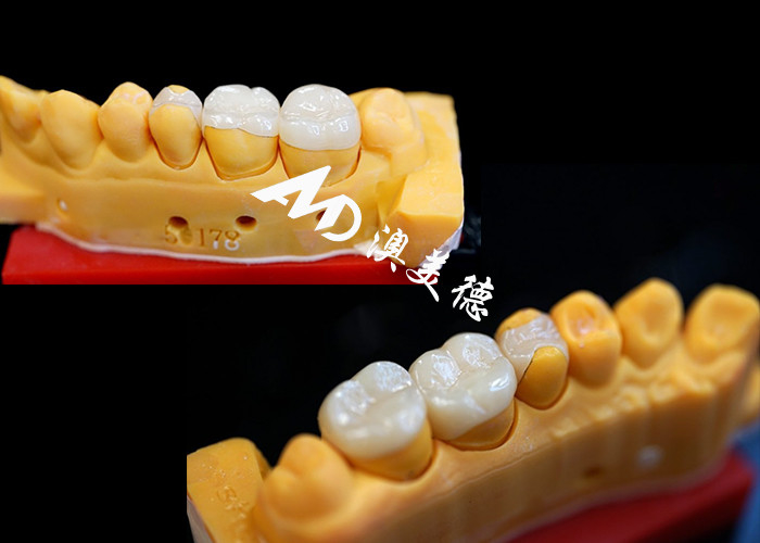 OEM Precision Fit Ceramic Inlays Onlays voor duurzame en natuurlijk uitziende tandheelkundige restauratie met superieure sterkte en betrouwbaarheid