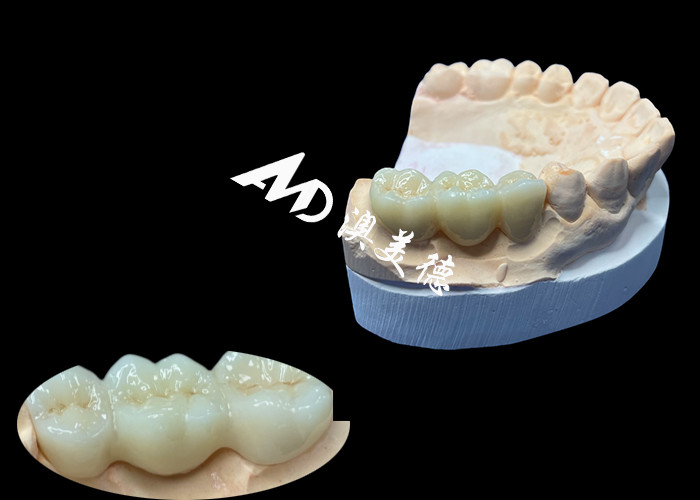 Natuurlijke kleur Zirconia tandheelkundige kroon scheurbestendige voor een vlekkeloze glimlach van China tandheelkundig lab