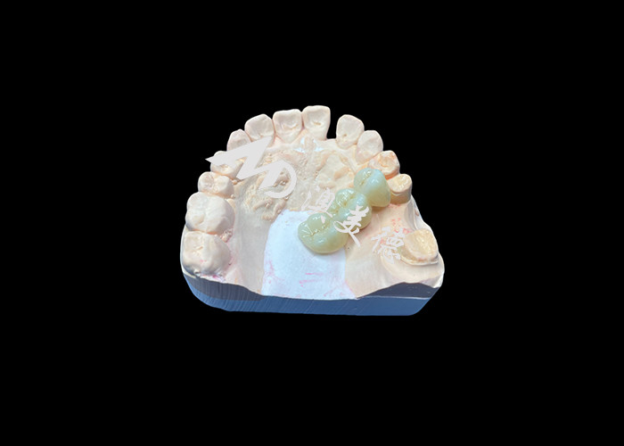 Natuurlijke kleur Zirconia tandheelkundige kroon scheurbestendige voor een vlekkeloze glimlach van China tandheelkundig lab