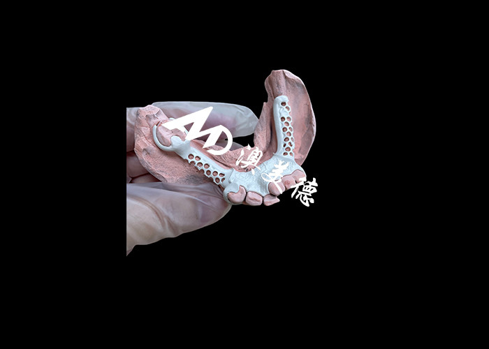 Afneembare prothese met HPP-frame en acrylbasis voor meer duurzaamheid en comfort
