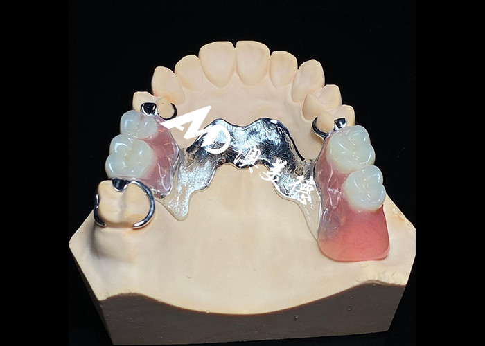 Afneembare tandheelkunde met gegoten metalen frame voor superieure sterkte en stabiliteit met langdurig comfort