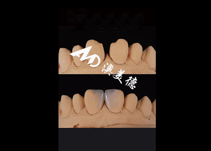 0.3-0.5mm Ultra dunne IPS EMAX porselein veneers voor esthetische glimlach makeovers