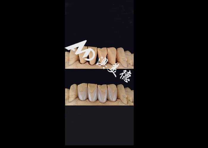 0.3-0.5mm Ultra dunne IPS EMAX porselein veneers voor esthetische glimlach makeovers