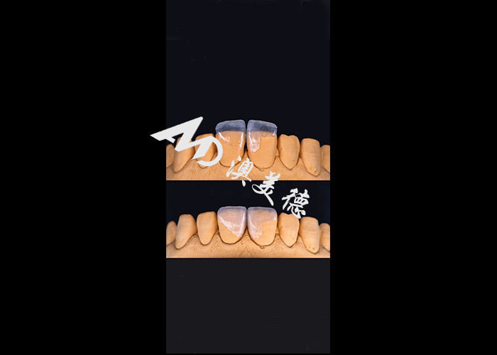 0.3-0.5mm Ultra dunne IPS EMAX porselein veneers voor esthetische glimlach makeovers