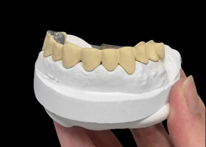 Metalen kroon gesmolten porselein dat duurzaamheid en schoonheid combineert voor tandgezondheid