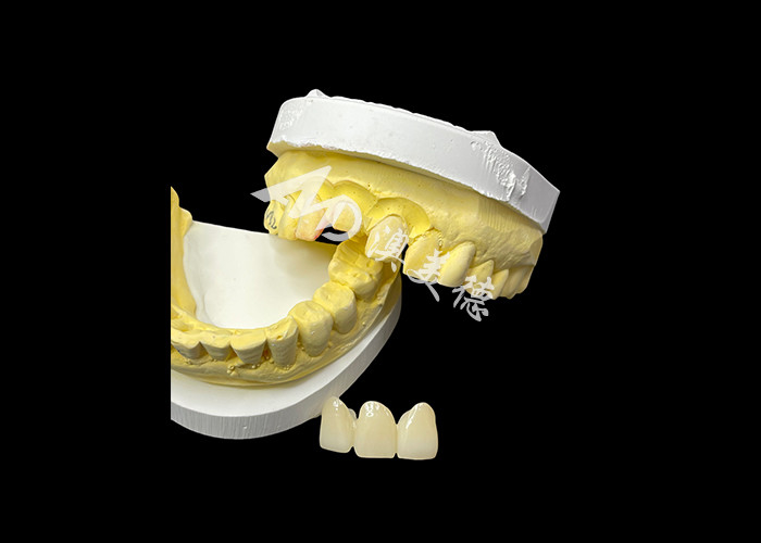 Verbeter uw tandheelkundige esthetiek met een keramische kroonbrug die uitzonderlijke esthetiek en uitstekende biocompatibiliteit combineert voor een natuurlijke, comfortabele glimlach