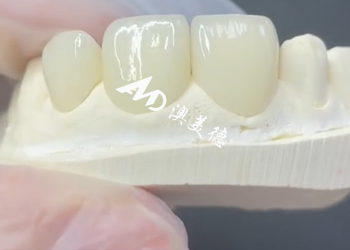Duurzaam en esthetisch EMAX fineer De perfecte oplossing voor porseleinen restauratie