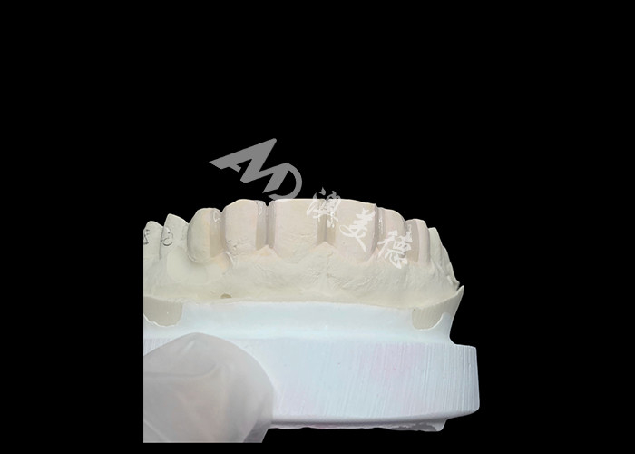 IPS Emax veneers Minimale voorbereiding/Geen voorbereiding Veneers zijn innovatieve oplossingen voor een mooie glimlach