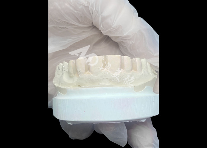IPS Emax veneers Minimale voorbereiding/Geen voorbereiding Veneers zijn innovatieve oplossingen voor een mooie glimlach