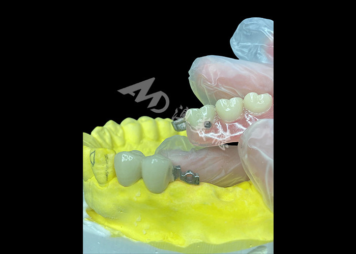 Gepersonaliseerde PFM + Afneembare tandheelkundige combinatie De ultieme oplossing voor comfort en esthetiek