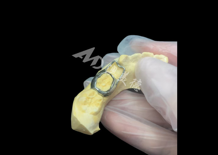 Orthodontic Space maintainer een onbetaalbaar apparaat dat ingenieus de tandkloof van kinderen beschermt en zorgt voor een goede tandontwikkeling.