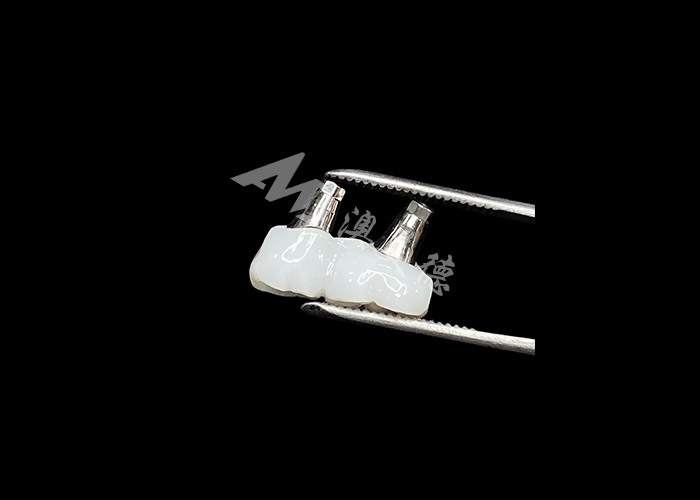 Zirconia tandheelkundige implantaten kronen met titanium onderstel voor een verbeterd comfort en esthetiek