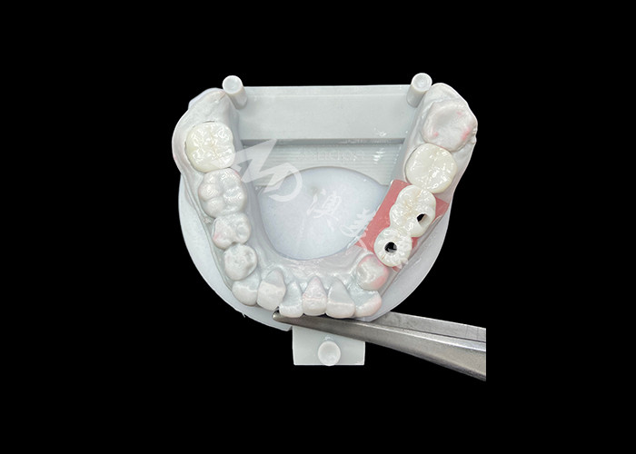 Zirconia tandheelkundige implantaten kronen met titanium onderstel voor een verbeterd comfort en esthetiek