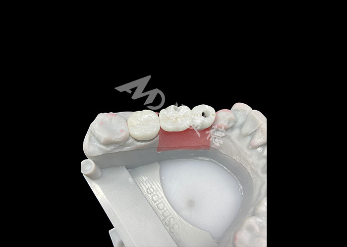 Zirconia tandheelkundige implantaten kronen met titanium onderstel voor een verbeterd comfort en esthetiek