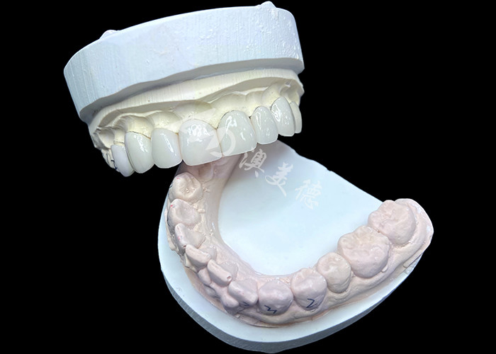 IPS e.max veneers in de kleur BL2 bereiken een prachtige natuurlijke esthetiek met 8 perfect vervaardigde eenheden
