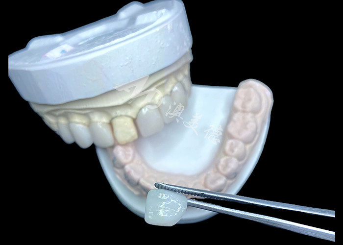 IPS e.max veneers in de kleur BL2 bereiken een prachtige natuurlijke esthetiek met 8 perfect vervaardigde eenheden
