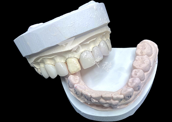 IPS e.max veneers in de kleur BL2 bereiken een prachtige natuurlijke esthetiek met 8 perfect vervaardigde eenheden