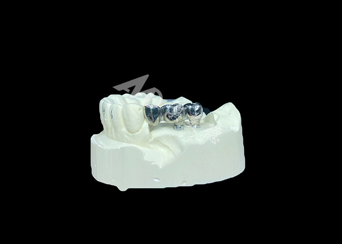 Langdurige full cast titanium kroon tandheelkundige implantaten molar voor ontbrekende tanden vervanging