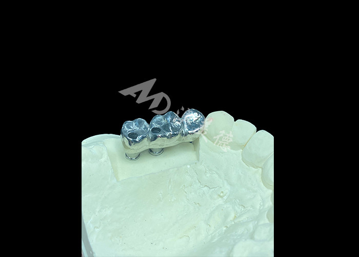 Langdurige full cast titanium kroon tandheelkundige implantaten molar voor ontbrekende tanden vervanging