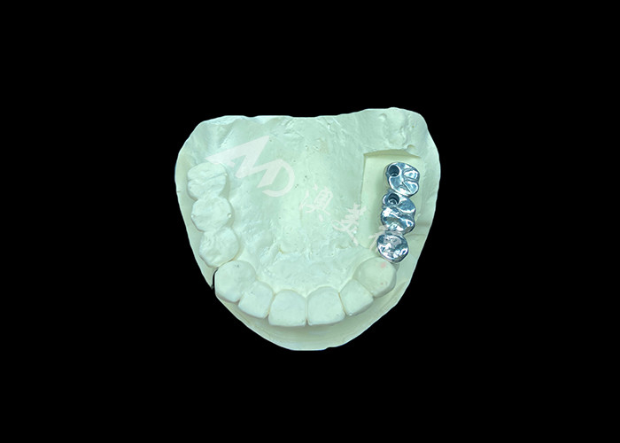 Langdurige full cast titanium kroon tandheelkundige implantaten molar voor ontbrekende tanden vervanging