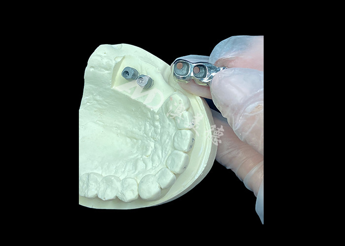 Langdurige full cast titanium kroon tandheelkundige implantaten molar voor ontbrekende tanden vervanging