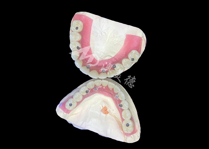Dental All-on-6 tandheelkundige implantaten ondersteunde gebit met stabiliteit en comfort
