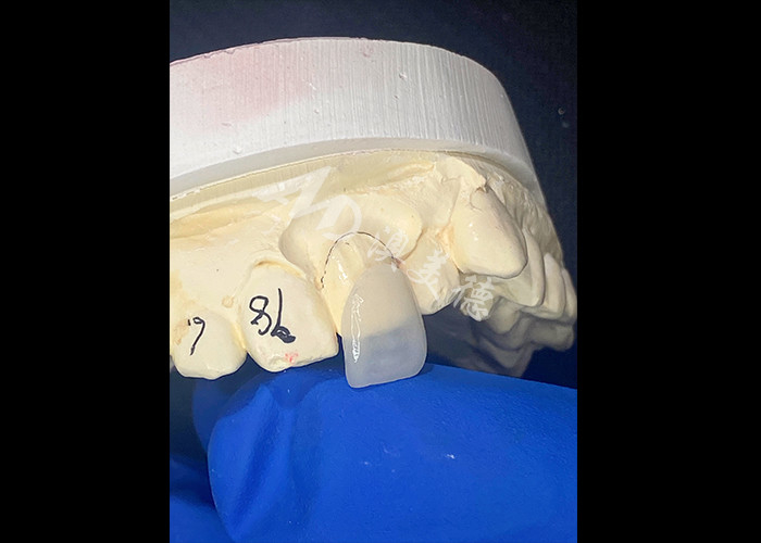 IPS e.max Finissen voor snijtanden in de kleur A1 Natuurlijke esthetiek voor een vlekkeloze glimlach