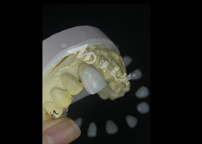 Precies vervaardigde IPS e.max veneers voor ongeëvenaarde glimlachtransformaties met een uitzonderlijke duurzaamheid