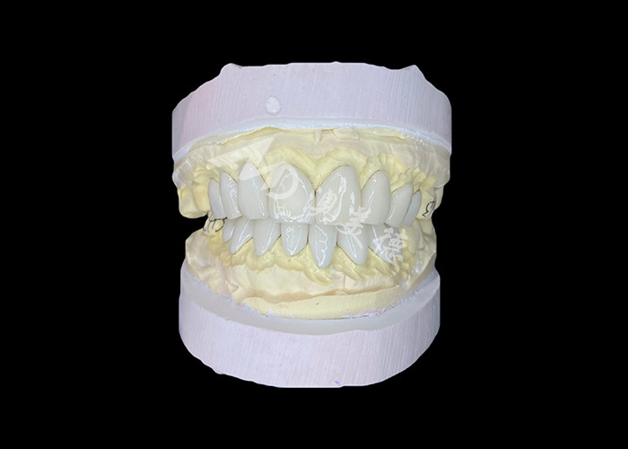 Precies vervaardigde IPS e.max veneers voor ongeëvenaarde glimlachtransformaties met een uitzonderlijke duurzaamheid
