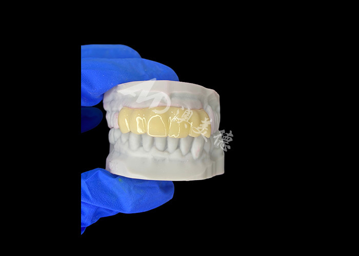 Lichte biovergelijkbare 3D-geprinte holle tijdelijke brug voor pre-implantatie-herstel