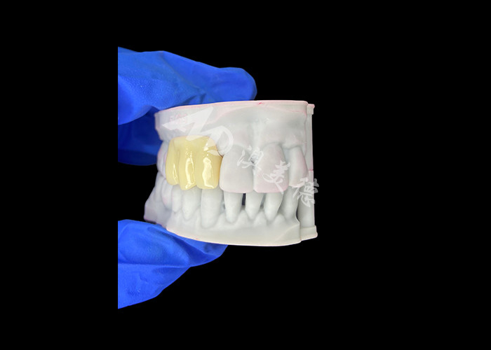 Lichte biovergelijkbare 3D-geprinte holle tijdelijke brug voor pre-implantatie-herstel