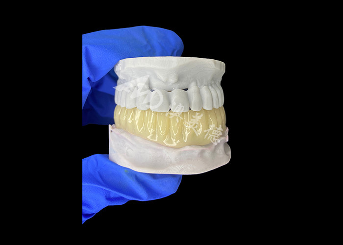 Lichte biovergelijkbare 3D-geprinte holle tijdelijke brug voor pre-implantatie-herstel