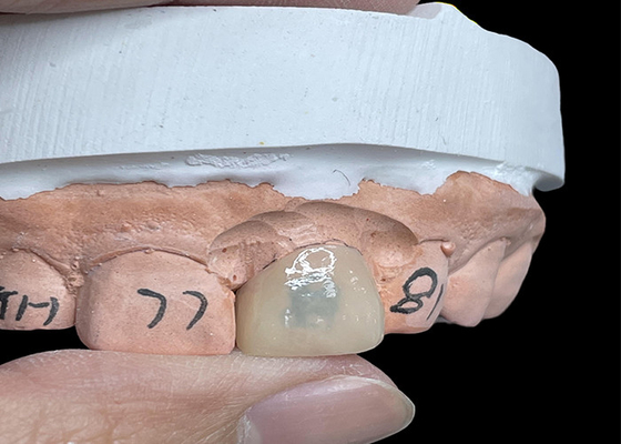 Goede prijs EMAX veneers veranderen je glimlach met zeer doorschijnende natuurlijke tanden online