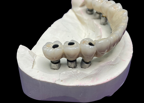 Goede prijs Het tandheelkundige implantaat met een titanium basis is bekleed met een prachtige keramische kroonbrug om een perfecte restauratie te creëren. online