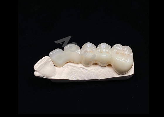 Goede prijs Translucentie Natuurlijke esthetiek Vaste Zirconia kroon voor tanden online