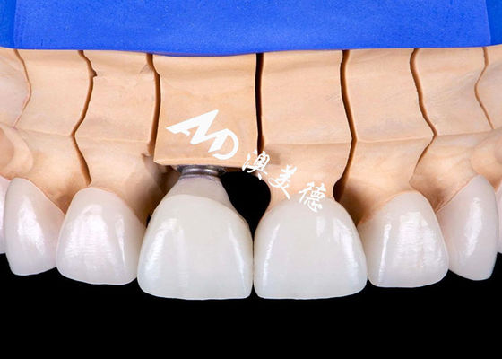 Goede prijs Biocompatibele tandheelkundige implantaten van titanium legering met natuurlijke uitstraling online