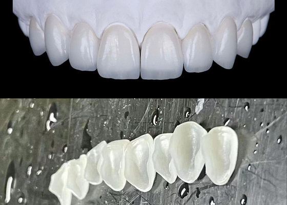 Goede prijs IPS emax Pers porselein veneers bereiken een natuurlijke en stralende glimlach online