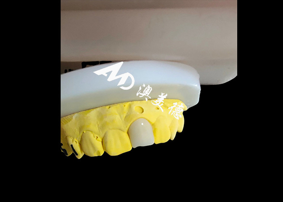 Goede prijs Natuurlijk uitziende esthetische Zirconia tandkronijn Onberispelijke tandherstel online