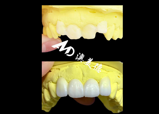 Goede prijs Op maat gemaakte doorzichtige Zirconia tandkronen gemaakt door AMD Dental Lab online