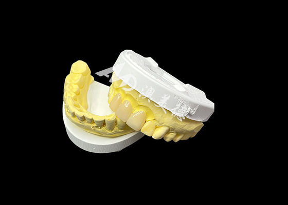 Goede prijs Verbeter uw tandheelkundige esthetiek met een keramische kroonbrug die uitzonderlijke esthetiek en uitstekende biocompatibiliteit combineert voor een natuurlijke, comfortabele glimlach online
