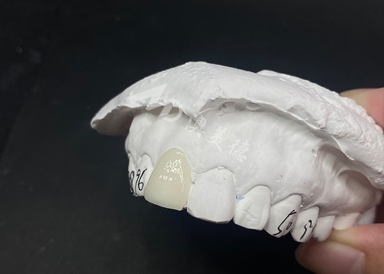 Goede prijs Doorzichtige aangepaste tandheelkundige veneers snelle en effectieve oplossingen voor een blijvende glimlach online