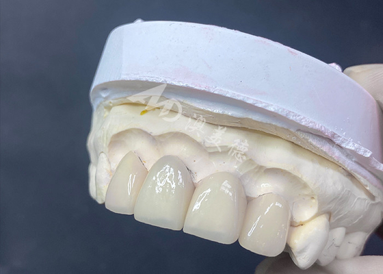Goede prijs Voortreffelijk gefabriceerde tandheelkundige veneers Uitstekende pasvorm en hoge doorschijnendheid voor een onberispelijke glimlach online