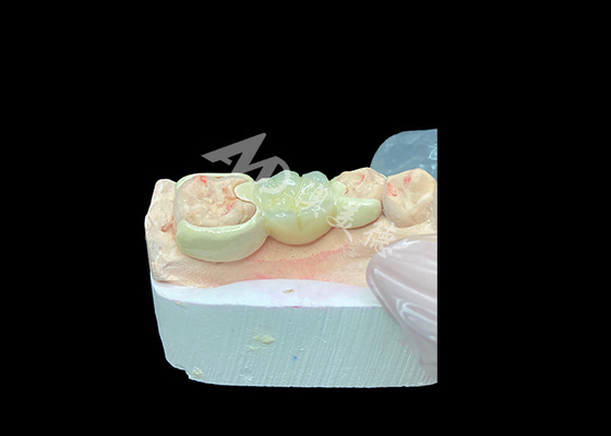 Goede prijs Zirconia kroon met HPP gebonden brug voor verbeterde glimlach esthetiek en biocompatibiliteit online