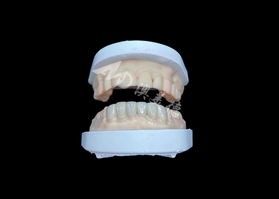 Goede prijs IPS Emax Veneers Natuurlijke uitstraling Restoraties voor een esthetische glimlach online
