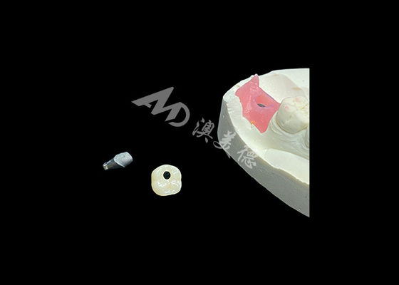 Goede prijs Kroon op tandimplantaat: een revolutie in de restauratieve tandheelkunde online