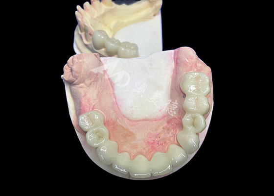 Goede prijs Natuurlijke uitstraling Lava Zirconia kroon met ongeëvenaarde duurzaamheid Uitstekende biocompatibiliteit online