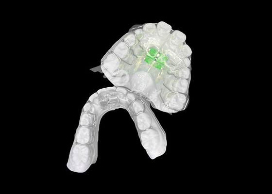 Goede prijs Een effectieve verwijderbare orthodontische expander voor een optimale kaakbalans en tandgezondheid online