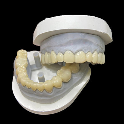Goede prijs PMMA Temporary Restorations CAD/CAM PMMA Crowns and Bridges for Provisional Dental Cases online