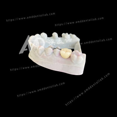 Goede prijs PFM Maryland Bridge One Pontic Two Wings Een conservatieve en esthetische oplossing online